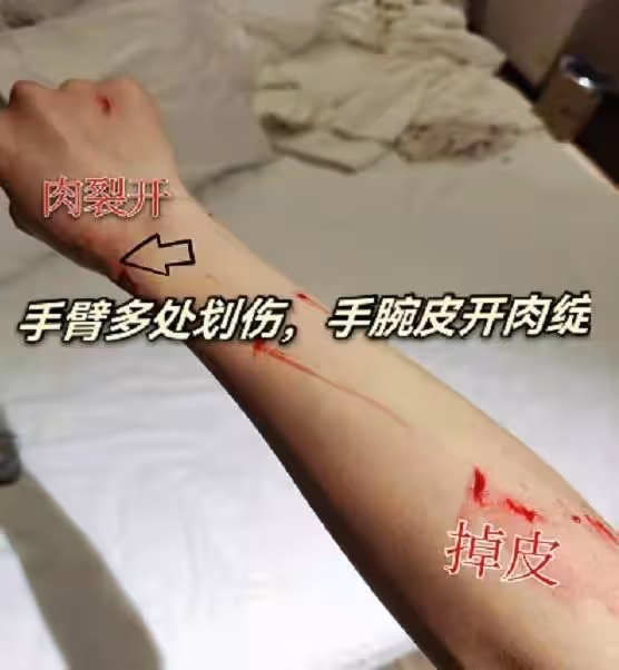 40歲男星洗澡時玻璃門爆裂!身體多處被割傷流血,一地碎片太可怕