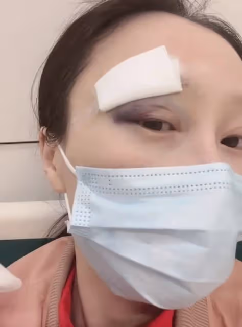 35歲女星出意外臉上縫9針!稱親手斷送演藝生涯,估計要退圈了