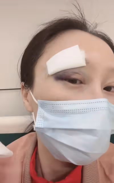 35歲女星意外毀容要退圈!眼角淤青縫九針,曾自曝產後患病想跳樓
