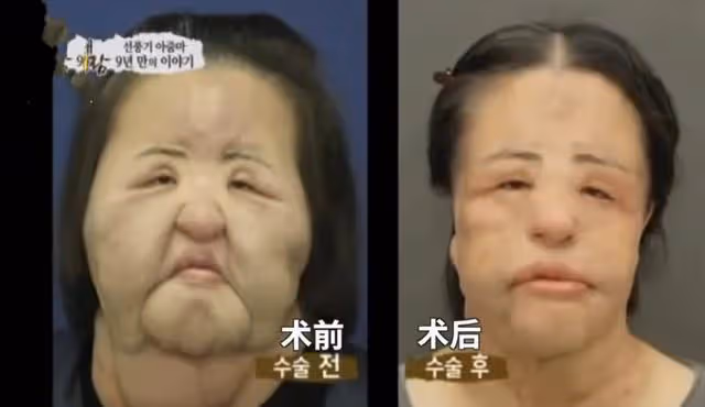 「整容上癮」韓慧景:把臉整成電風扇,自行注射食用油,代價慘痛