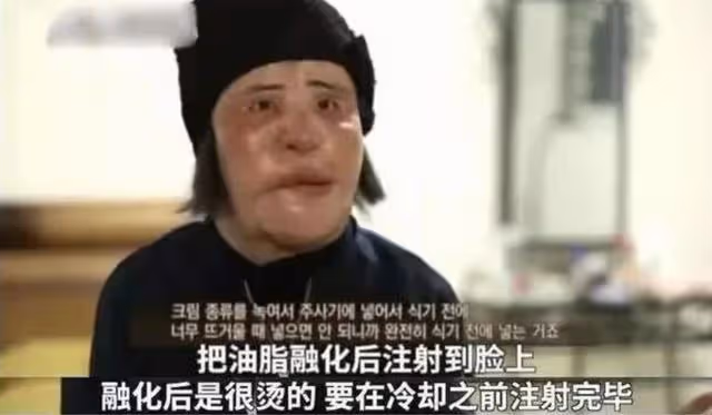 「整容上癮」韓慧景:把臉整成電風扇,自行注射食用油,代價慘痛