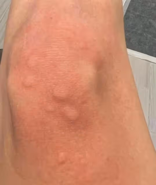 禍不單行!TVB女星高燒求醫中途遇車禍,車輛有碰撞但幸得人沒事