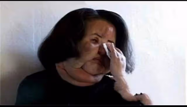 她整容上癮,為變美給臉打食用油,把臉整成電風扇,57歲去世