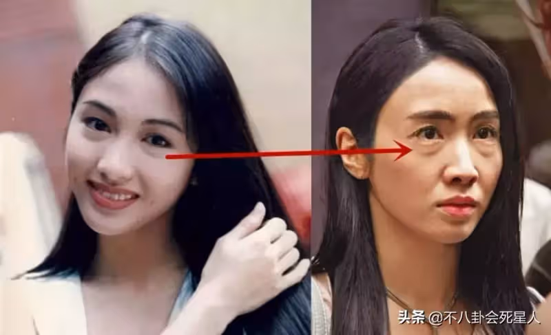 明星熱衷割眼袋，有人立馬年輕20歲，有人卻僵到笑不出來