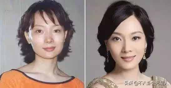 假體亂飛、笑比哭還難看!動臉後的「矽膠臉」才是最恐怖的