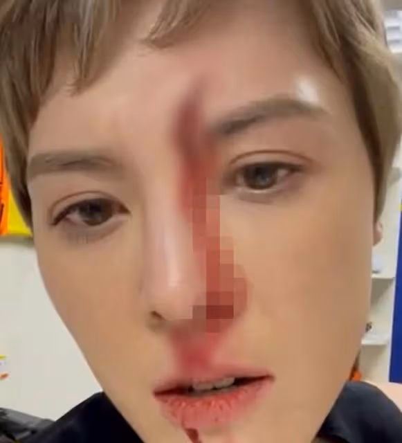 32歲女星與苗僑偉對戲出意外!眼球被炸傷太可怕,仍要求繼續拍攝