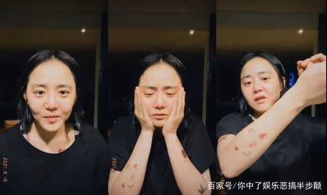 文根英曬照意外曝光4次手術免於截肢,留下的幾十厘米傷疤!