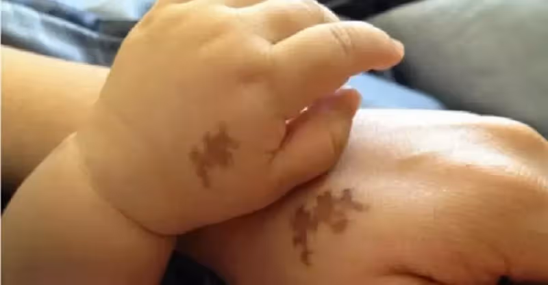 是巧合？閨蜜女兒手上的「特殊胎記」和老公一模一樣 妻子「得知真相後」瞬間崩潰