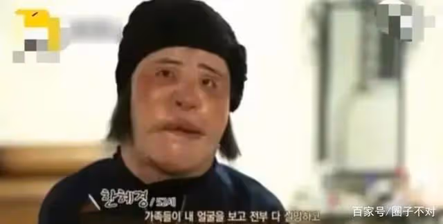 2018年韓慧景去世，年輕時在臉上注射色拉油，因整容過度幾乎毀容