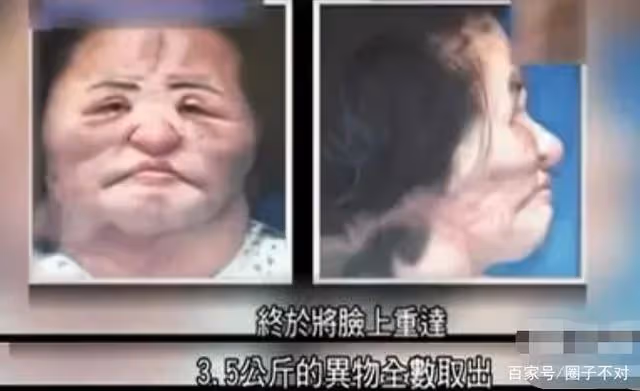 2018年韓慧景去世，年輕時在臉上注射色拉油，因整容過度幾乎毀容