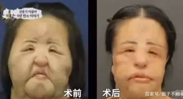 2018年韓慧景去世，年輕時在臉上注射色拉油，因整容過度幾乎毀容