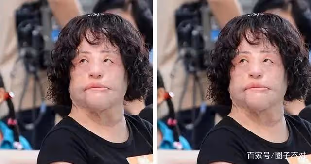 2018年韓慧景去世，年輕時在臉上注射色拉油，因整容過度幾乎毀容