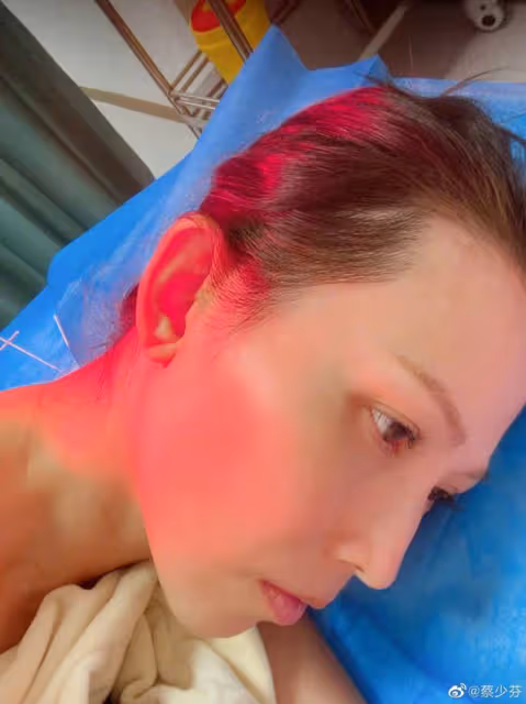 當媽媽不容易，蔡少芬帶兒子累出筋膜炎肩周炎，曬針灸照惹人心疼