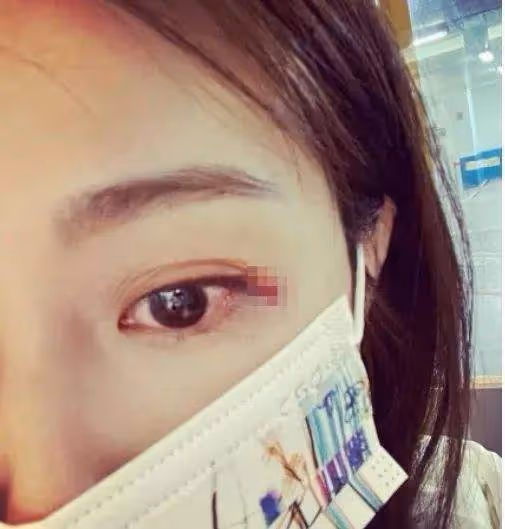 飛來橫禍！31歲女星不慎被推車撞頭當場想吐，醫生證實眼角撕裂