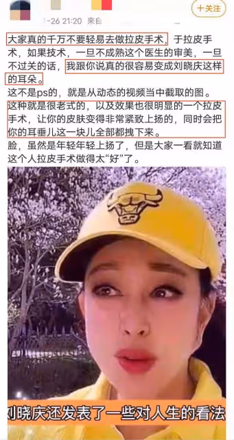 劉曉慶出鏡被指臉太嚇人,面部凹凸不平沒有皺紋,曾多次回復整容