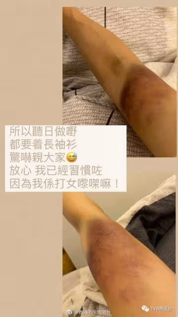 打到周身傷龔嘉欣慣咗唔識痛!