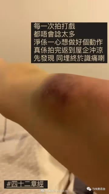 打到周身傷龔嘉欣慣咗唔識痛!