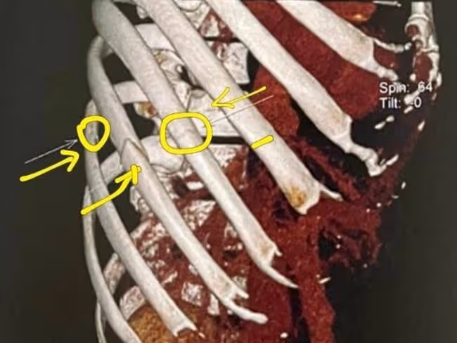 譚耀文太敬業!撞裂3根肋骨劇痛半休克,仍堅持拍戲次日才去醫院