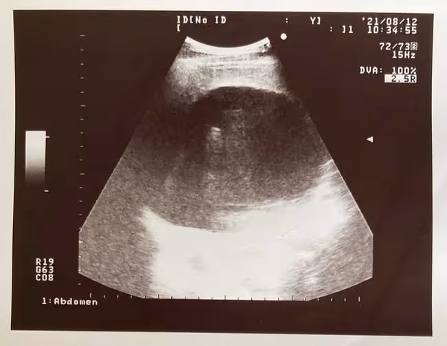 66歲男星長巨型腫瘤拒化療,已寫好遺書,留新房及保險給小10歲妻
