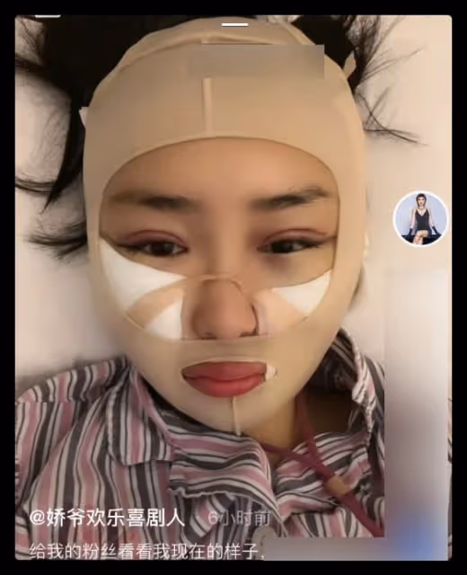本山傳媒嬌嬌自曝整容,曬術後照被指認不出,多次割眼皮腫脹明顯