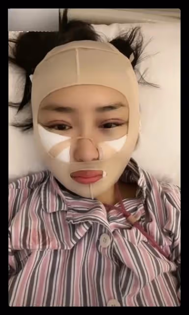 本山傳媒嬌嬌自曝整容,曬術後照被指認不出,多次割眼皮腫脹明顯