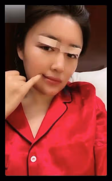 本山傳媒嬌嬌自曝整容,曬術後照被指認不出,多次割眼皮腫脹明顯