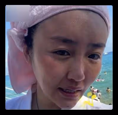 本山傳媒嬌嬌自曝整容,曬術後照被指認不出,多次割眼皮腫脹明顯