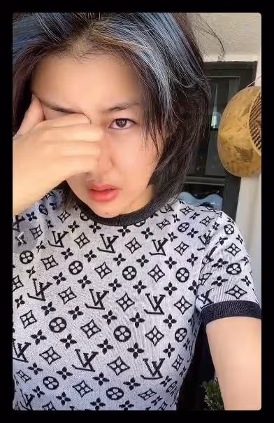 本山傳媒嬌嬌自曝整容,曬術後照被指認不出,多次割眼皮腫脹明顯