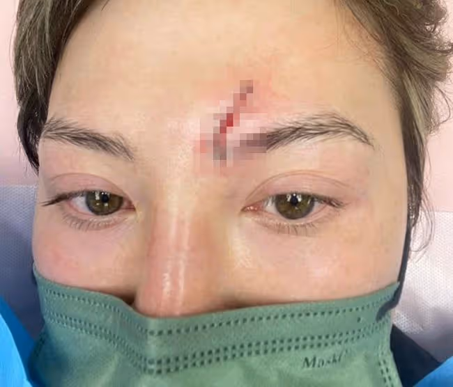 TVB藝人拍戲頻繁受傷!劉家良徒孫頭撞玻璃,緊急送醫後縫8針