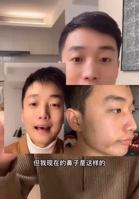 男網紅咽喉不適去醫院檢查,毫不知情被「整容」,鼻子坍塌慘毀容