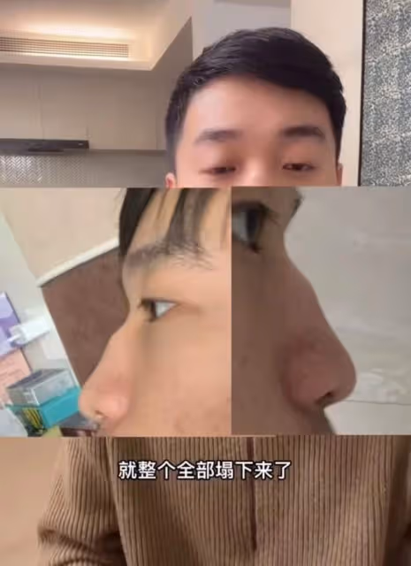 男網紅咽喉不適去醫院檢查,毫不知情被「整容」,鼻子坍塌慘毀容