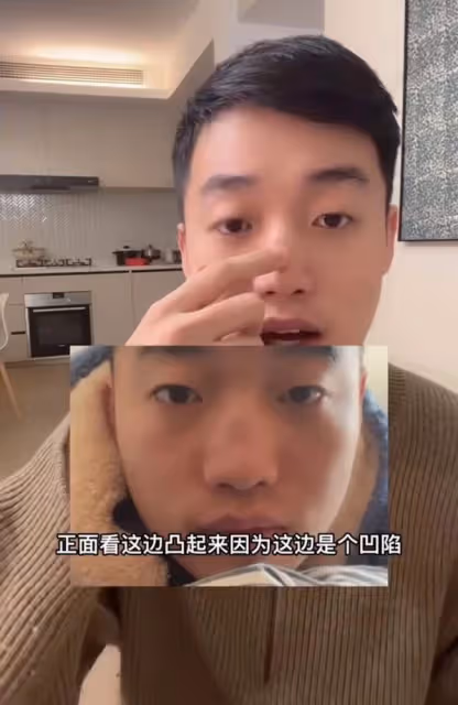 男網紅咽喉不適去醫院檢查,毫不知情被「整容」,鼻子坍塌慘毀容