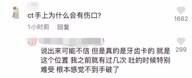 知名吃播小貝餓了又被指催吐!手指關節傷口似牙印,大批粉絲質疑