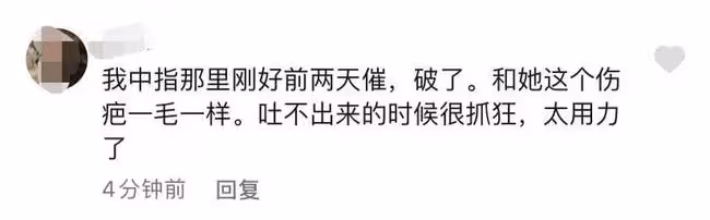 知名吃播小貝餓了又被指催吐!手指關節傷口似牙印,大批粉絲質疑