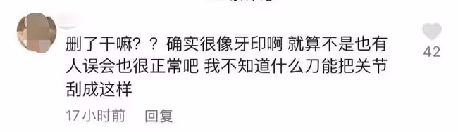 知名吃播小貝餓了又被指催吐!手指關節傷口似牙印,大批粉絲質疑