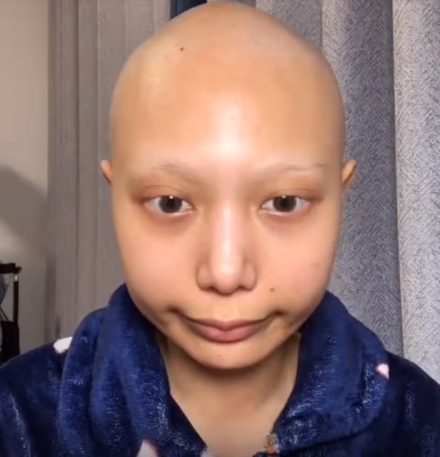 又一網紅患癌！22歲小羊剃光頭化療6次，已做切除手術將終身不孕