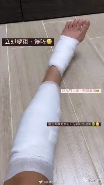 TVB小花撰分手文暗寸前度!美腿突然重創傷上加傷