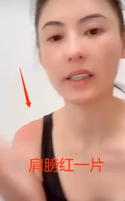 41歲張柏芝游泳穿太少!身上皮膚遭嚴重曬傷,兩邊肩膀「紅一大片」,網:一定要注意防曬啊