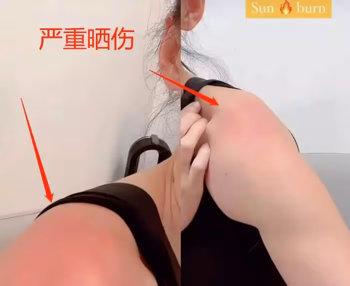 41歲張柏芝游泳穿太少!身上皮膚遭嚴重曬傷,兩邊肩膀「紅一大片」,網:一定要注意防曬啊