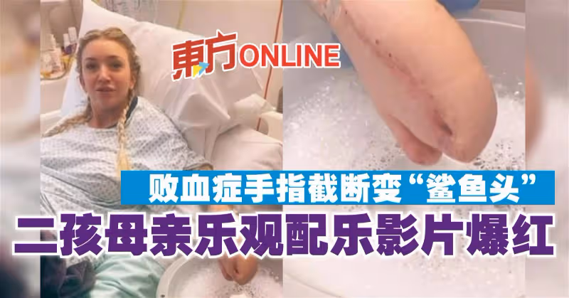 敗血症手指截斷變「鯊魚頭」　二孩母親樂觀配樂影片爆紅