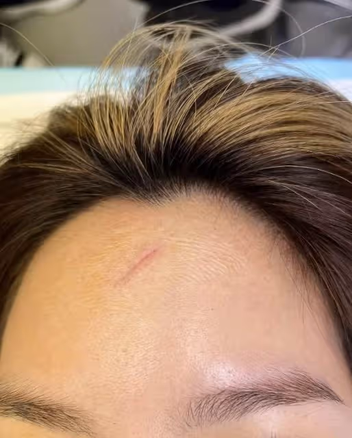 遺憾！TVB知名女星突然與身家3億男友分手，錄節目受傷縫了16針