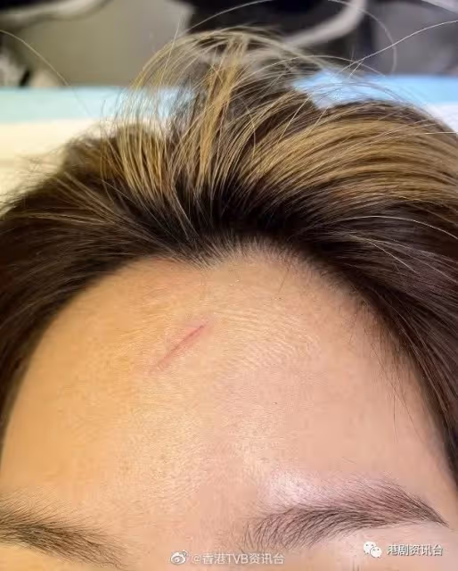 自爆與男友已分手半年！TVB小花獲方力申承擔醫藥費