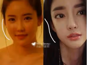 花十億整容成baby，後發展成網紅瘋狂撈金