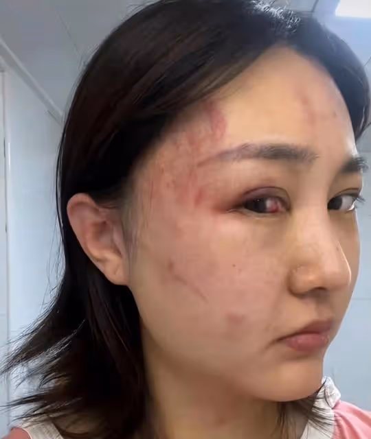34歲女星慘遭家暴！深夜被拖拽進房間打到眼睛出血，絕望發聲求助