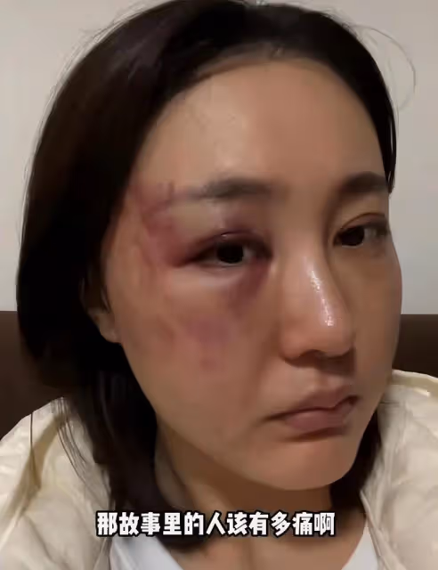 34歲女星慘遭家暴！深夜被拖拽進房間打到眼睛出血，絕望發聲求助