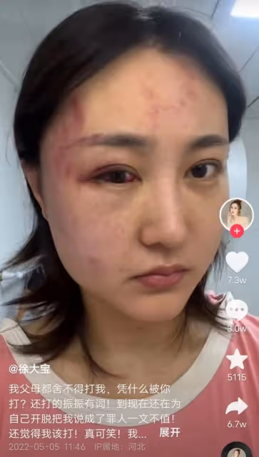 34歲女演員被家暴，拖進房間打到眼腫充血，絕望發聲只為離婚