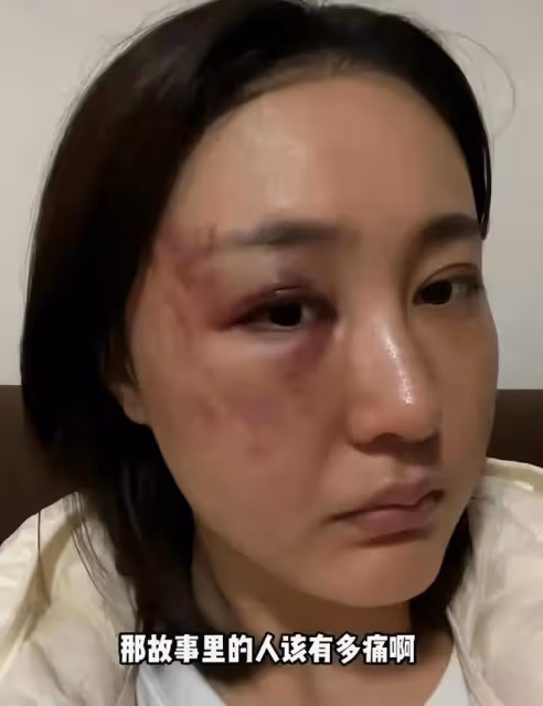 34歲女演員被家暴，拖進房間打到眼腫充血，絕望發聲只為離婚