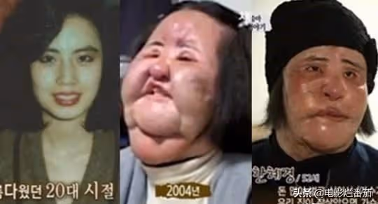 整容成癮韓慧景：把臉整得面目全非，給自己注射機油，後悔莫及