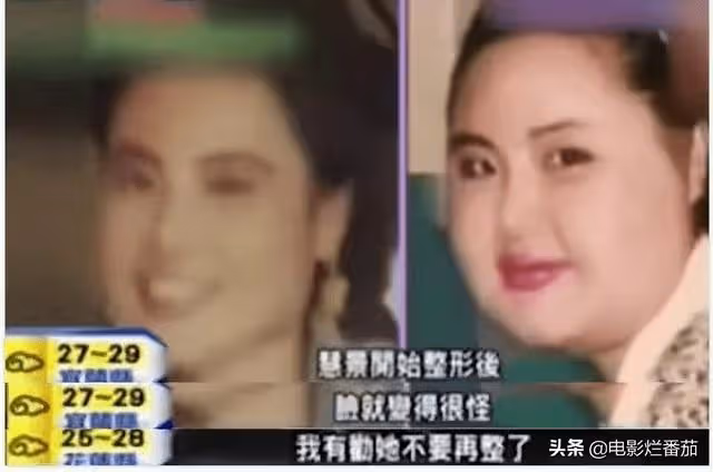 整容成癮韓慧景：把臉整得面目全非，給自己注射機油，後悔莫及