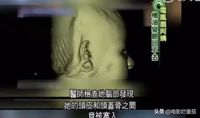 整容成癮韓慧景：把臉整得面目全非，給自己注射機油，後悔莫及